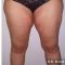 Chirurgie des cuisses