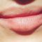 Lip augmentation - cheiloplasty