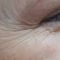BOTOX®