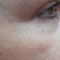 BOTOX®