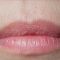 Lip augmentation - cheiloplasty