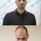 Hair Transplant