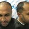 Hair Transplant