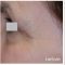 Botulinum toxin - Wrinkle Removal