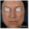 Botulinum toxin - Wrinkle Removal