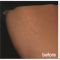 Stretch marks
