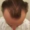 Hair Transplant