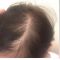 Hair Transplant