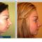 Rhinoplastie