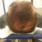 Trapianto capelli