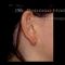 Otoplastia