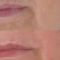 Filler
