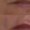 Filler