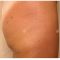 Alternativa alla liposuzione - rimozione del grasso e della cellulite non invasiva