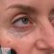 Spider veins laser removal (redness, birh marks)