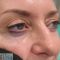 Spider veins laser removal (redness, birh marks)