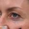 Spider veins laser removal (redness, birh marks)