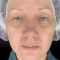 Fotorejuvenation