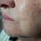 Teosyal, Restylane, Esthelis, Juverdem, Surgiderm (preparáty kyseliny hyaluronovej)