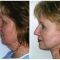 Face lift – Gold Threads