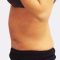 Abdominoplastika (Operace břicha)