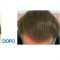 Trapianto capelli
