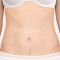Abdominoplastika (Operácia brucha)