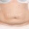 Abdominoplastika (Operácia brucha)