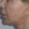Facelift, Lifting twarzy (podciąganie powłok twarzy)