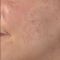 Fraxel® Laser