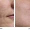 Acne Scars Treatment