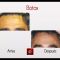 Botox/Dysport - Eliminar arrugas