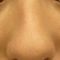 Plastika nosu (Rhinoplastika)