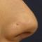 Plastika nosu (Rhinoplastika)