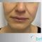 Teosyal, Restylane, Esthelis, Juverdem, Surgiderm (preparáty kyseliny hyaluronovej)