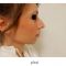Rhinoplasty (Nose Job)