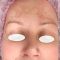 Intense pulse light Treatment (IPL)
