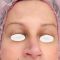Intense pulse light Treatment (IPL)