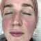 Intense pulse light Treatment (IPL)