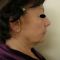 Cheek Lift