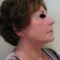 Cheek Lift