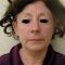 Cheek Lift
