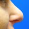 Plastika nosu (Rhinoplastika)