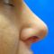 Plastika nosu (Rhinoplastika)