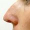 Plastika nosu (Rhinoplastika)