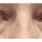 Korekcja powiek (Blepharoplastyka)