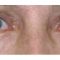 Korekcja powiek (Blepharoplastyka)