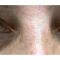 Korekcja powiek (Blepharoplastyka)