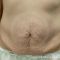 Abdominoplastyka (operacja powłok brzucha)