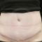 Abdominoplastyka (operacja powłok brzucha)